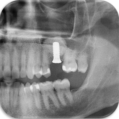 Dental Implants