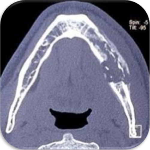 Osteomyeltis - Osteonecrosis