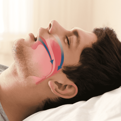 Sleep Apnea (OSAS)